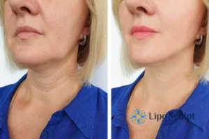Double chin before and after Hi-Fu treatment 4 Book your double chin treatment Telford today! We are here to help!