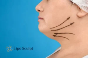 Double chin before and after Hi-Fu treatment 3 Boost your confidence with a Double chin treatment Telford