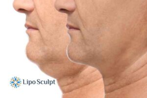 Double chin before and after Hi-Fu treatment 2 Double chin treatment Telford from Lipo Sculpt - feel more confident today!