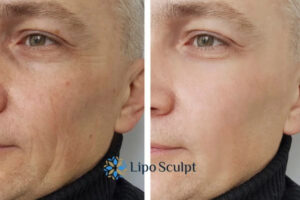 How to Fight Aging Symptoms 3 Fight Aging Symptoms Telford With HIFU and Morpheus8 Today!