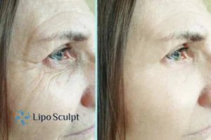 How to Fight Aging Symptoms 2 Do you want to Fight Aging Symptoms Telford? Contact Lipo Sculpt today!