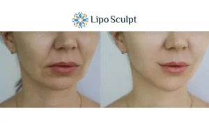 Explaining Morpheus8 And What It Can Do For You 2 Do you want to boost your self confidence? Give Morpheus8 Telford a try today!