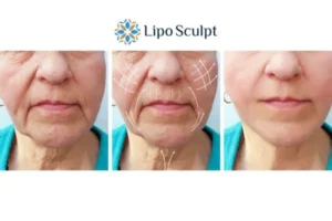 Explaining Morpheus8 And What It Can Do For You 3 Boost your confidence with Morpheus8 Telford call our team today!