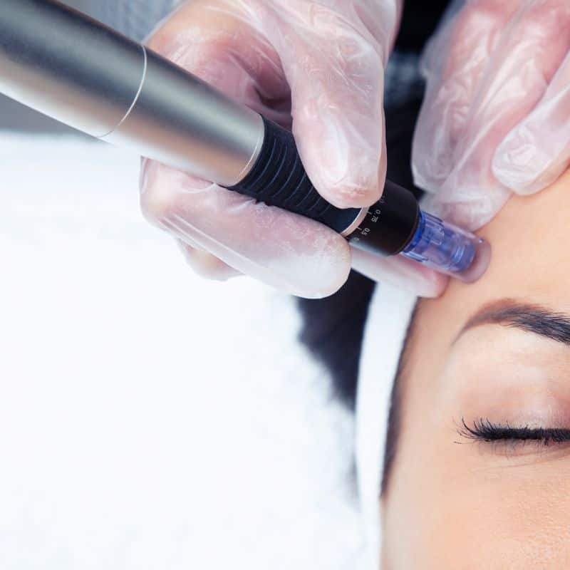 Morpheus8 treatment Telford from Lipo Sculpt - Book in today!