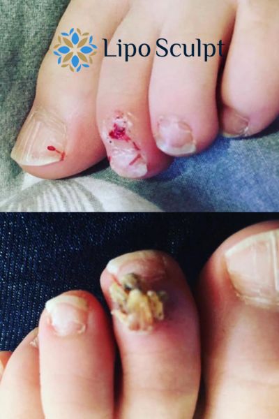 Wart removal customer results from Lipo Sculpt Telford