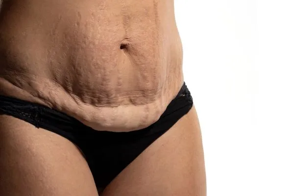 Lost the Weight but Not the Loose Skin? 1 image of womans stomach after weight loss showing loose skin Telford
